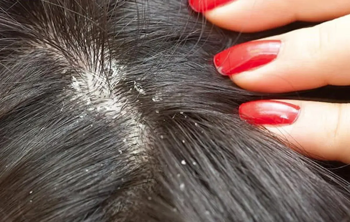 نشانه های که به شما می گوید شپش دارید