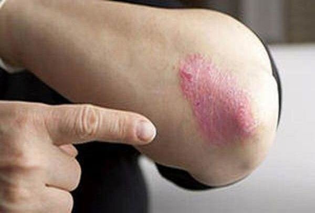 از بیماری «پسوریازیس» چه می دانید؟