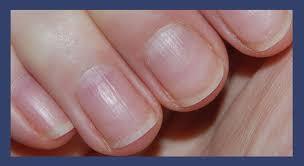 به این دلیل تغییرات ناخن را جدی بگیرید