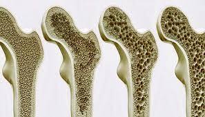 وقتی کودکان دچار پوکی استخوان می‌شوند