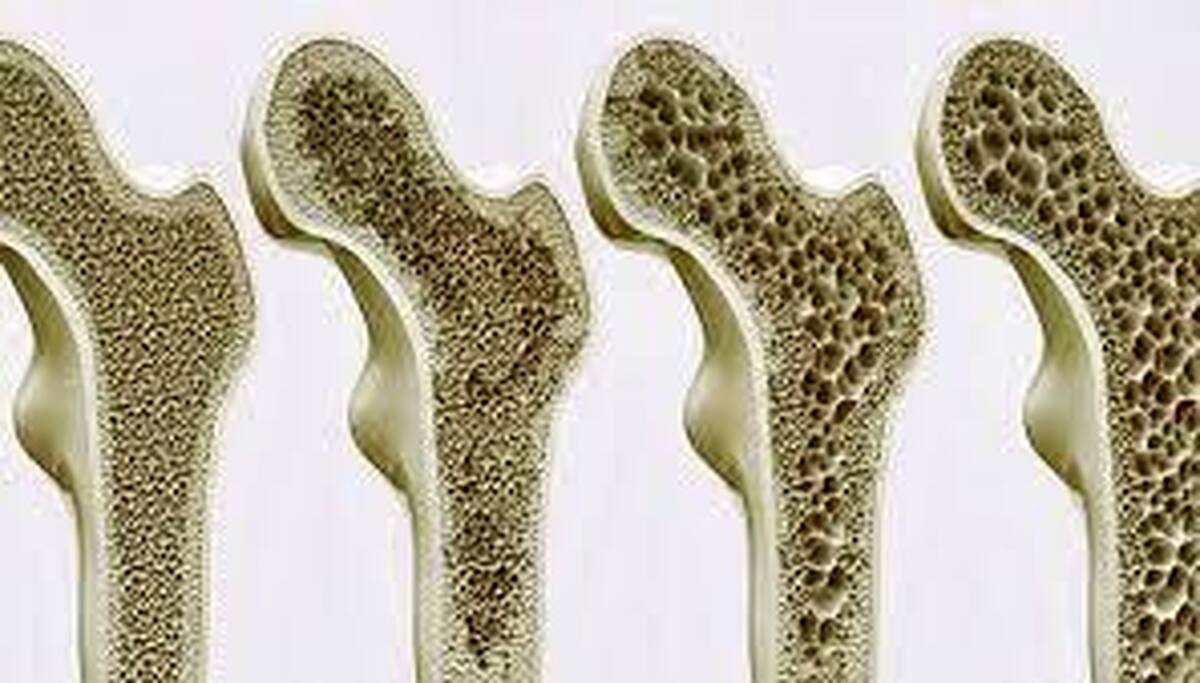 وقتی کودکان دچار پوکی استخوان می‌شوند