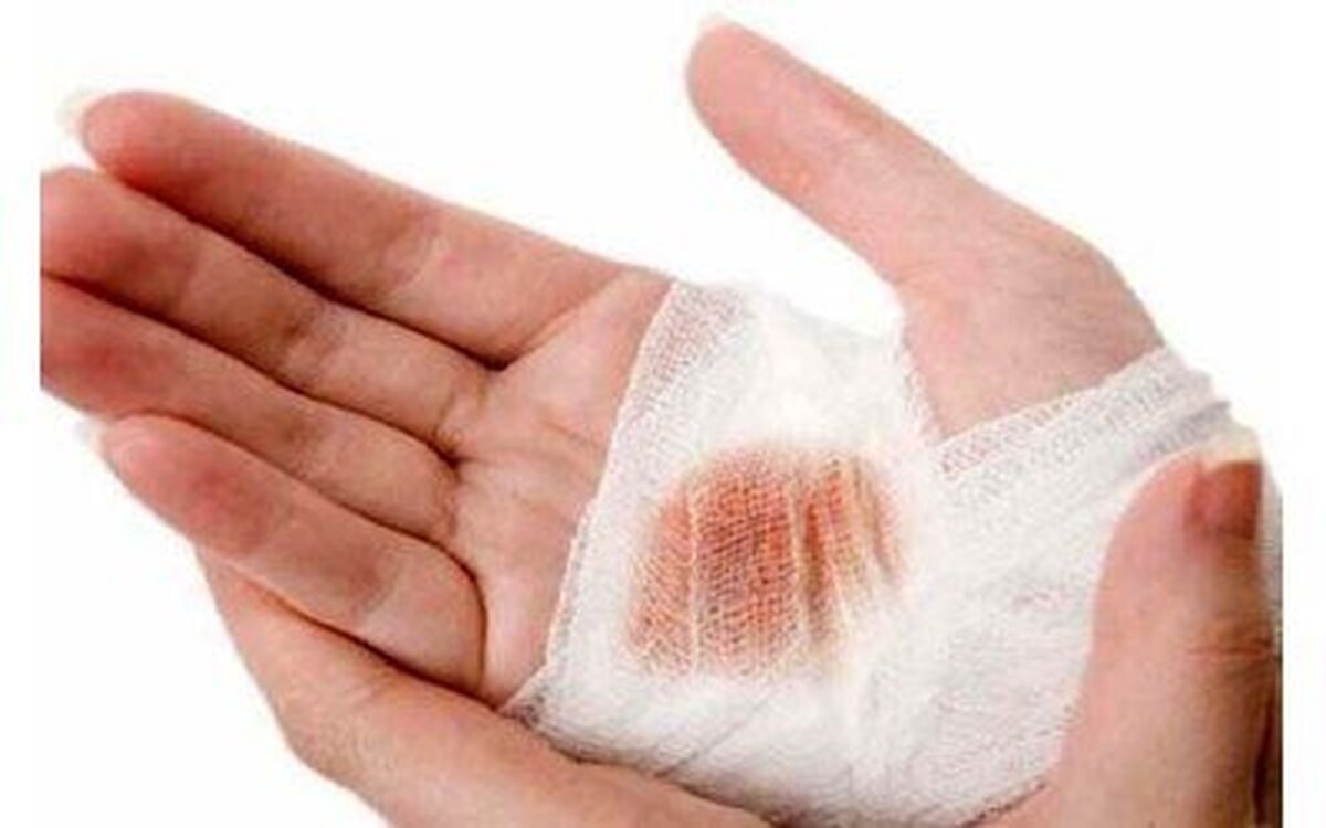 بهبود زخم قرنیه با لنز تماسی جدید