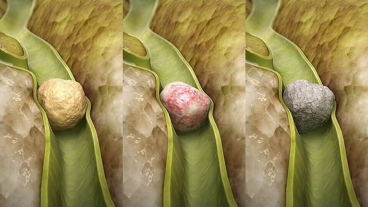 منشأ و انواع 