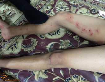 جراحت بر اثر اصابت گلولههای ساچمهای