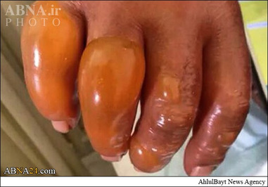 دست این رزمنده گمنام از شدت سرمای منطقه القلمون یخ زده و بعد تاول زده است