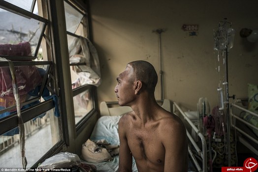 این تصویر جولیو رافائل  پاروچو است که از یک بیماری جدی در ناحیه جمجه رنج میبرد.