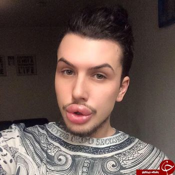 جیمز هالت پس از جراحی پلاستیک