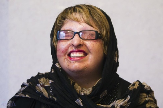 آمنه بهرامی قربانی اسیدپاشی در ایران