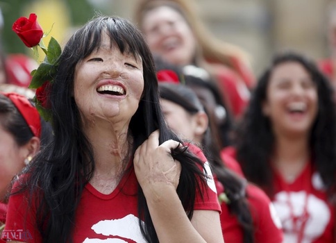 قربانی اسیدپاشی در کلمبیا