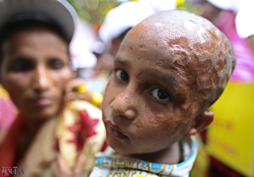 قربانی خردسال اسیدپاشی در بنگلادش