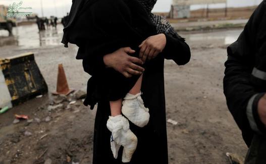 پاهای مجروح دختر عراقی آواره شده از غرب موصل
