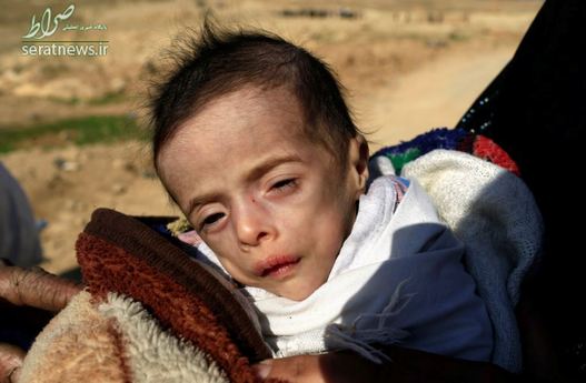بتول بشیر احمد کودک 5 ماهه عراقی که از خانه اش در موصل آواره شده مبتلا به کم شدن آب بدن شده