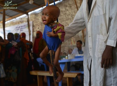درمان یک کودک سومالیایی که دچار سوءتغذیه شده 
