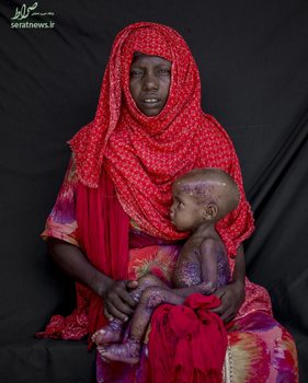 یک زن سومالیایی و دختر نوزادش که از سوءتغذیه شدید رنج می برد