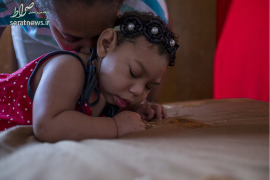 یک کودک مبتلا به زیکا در برزیل