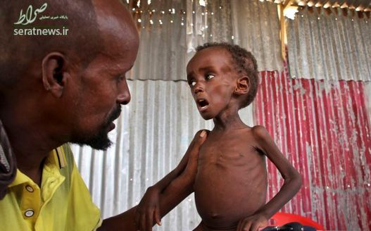 محمدعلی کودک 5 ساله سومالیایی که از سوء تغذیه رنج می برد