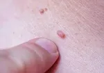 آیا درگیری با ویروس HPV حتما منجر به سرطان می‌شود؟/ ویدئو