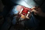 اولین جراحی بازکردن دریچه قلب در ایران؛ ۷۰ سال پیش + عکس