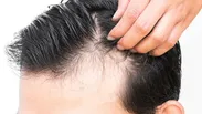 ۳ توصیه متخصص طب ایرانی برای جلوگیری از ریزش مو