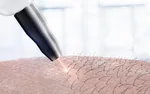 سلاح لیزری ترکیه برای نابودی موشک‌ها