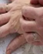 توصیه‌هایی برای جلوگیری از ابتلای دانش‌آموزان به «شپش سر»