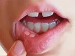 روش‌های پیشگیری و تشخیص سرطان حنجره