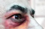 ردپای «قارچ سیاه» در ایران