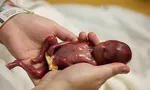زایمان طبیعی ایمن‌ترین روش زایمان در دنیا | آمار سقط‌های غیرقانونی در کشور