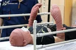 عکس / سرباز ۱۹ ساله قطع عضو شده اوکراینی در حال دریافت خدمات پزشکی