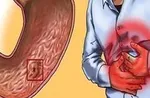 ۴ علت نفخ معده را بشناسید