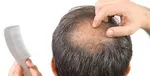 ۶ علت اصلی ریزش مو