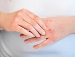 واکسن HPV در انتظار ورود به برنامه ملی ایمن‌سازی / اولویت با این افراد