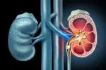 این رژیم غذایی خطر ابتلا به سنگ کلیه را افزایش می‌دهد