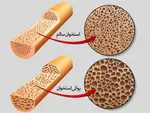 پوکی استخوان و ضعف ایمنی بدن به‌دلیل کمبود این ویتامین