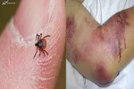 شناسایی ۳ بیمار قطعی مبتلا به تب کریمه کنگو در اردبیل