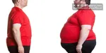تاثیر داروهای کاهش وزن در تسکین میگرن مزمن