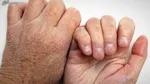 آمار بیماران جذامی در کشور
