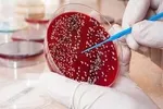 اصلی‌ترین دلایل تعریق شدید دست