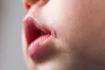 تبخال باعث آلزایمر می‌شود؟