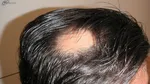 همه‌چیز درباره انواع ریزش موی سر + راهکار‌های درمان