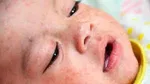 سر و کله ویروس سرخک از کجا پیدا شد؟