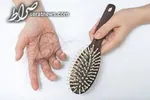 ۱۲ درمان مفید و کاربردی برای ریزش مو در زنان