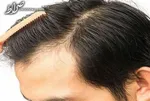 جلوگیری و درمان ریزش مو با این دمنوش‌های گیاهی