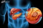 اینفوگرافیک /علائم مهم سرطان پروستات