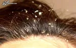 چگونه به کمک طب‌سنتی با شوره سر مقابله کنیم؟