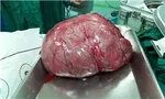 خارج‌ کردن توده ۱۰ کیلویی از شکم یک بیمار + عکس