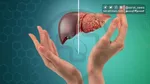 کبد چرب را با نسخه طب سنتی درمان کنید