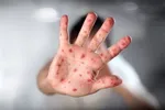 نرخ ابتلا به سرخک در ۲۷ سال اخیر در اروپا رکورد زد