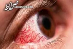 چند روش‌ ساده برای مراقبت از چشم