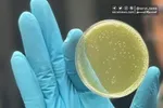 بهبود زخم قرنیه با لنز تماسی جدید